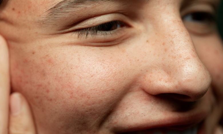 بهترین کرم برای جای جوش و لک صورت