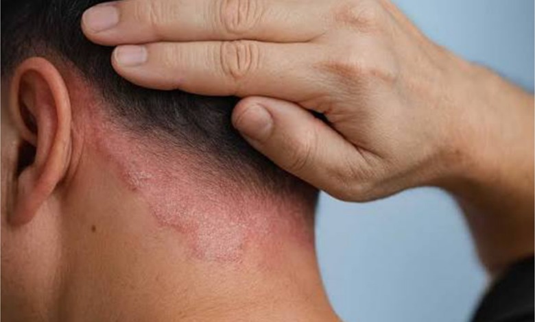 بهترین کرم برای درمان پسوریازیس