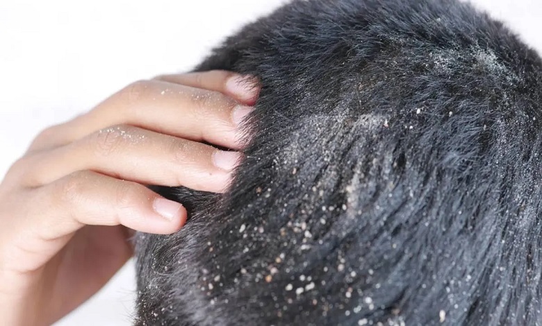 روش درمان پوسته پوسته شدن سر + علت پوست انداختن کف سر