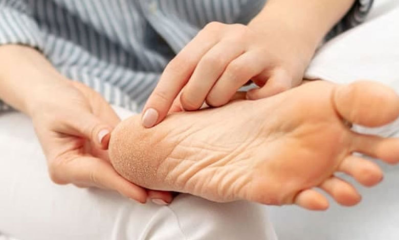 کمبود چه ویتامینی باعث ترک کف پا میشود؟