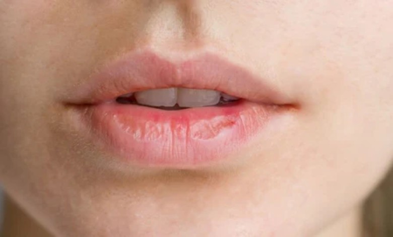 لبهای خشک