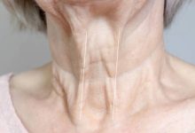 علت ایجاد خطوط گردن و راه‌های از بین بردن آن چیست؟