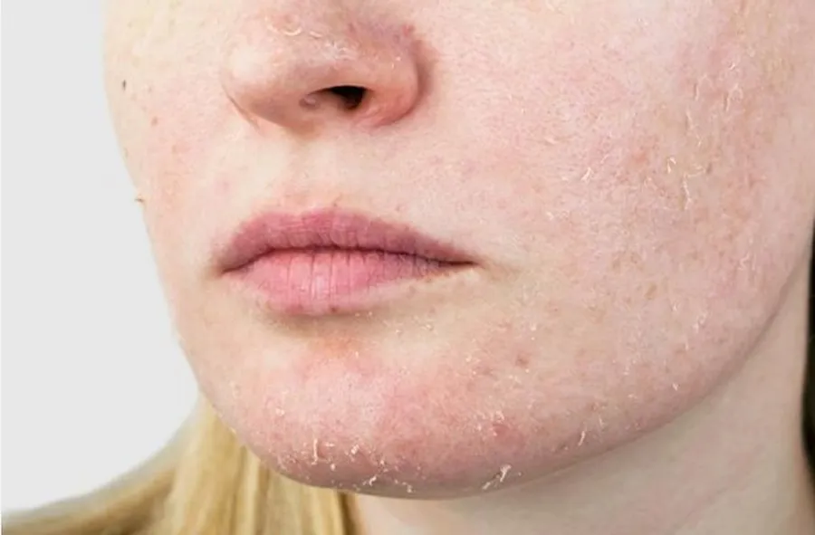 پوست‌های خشک 